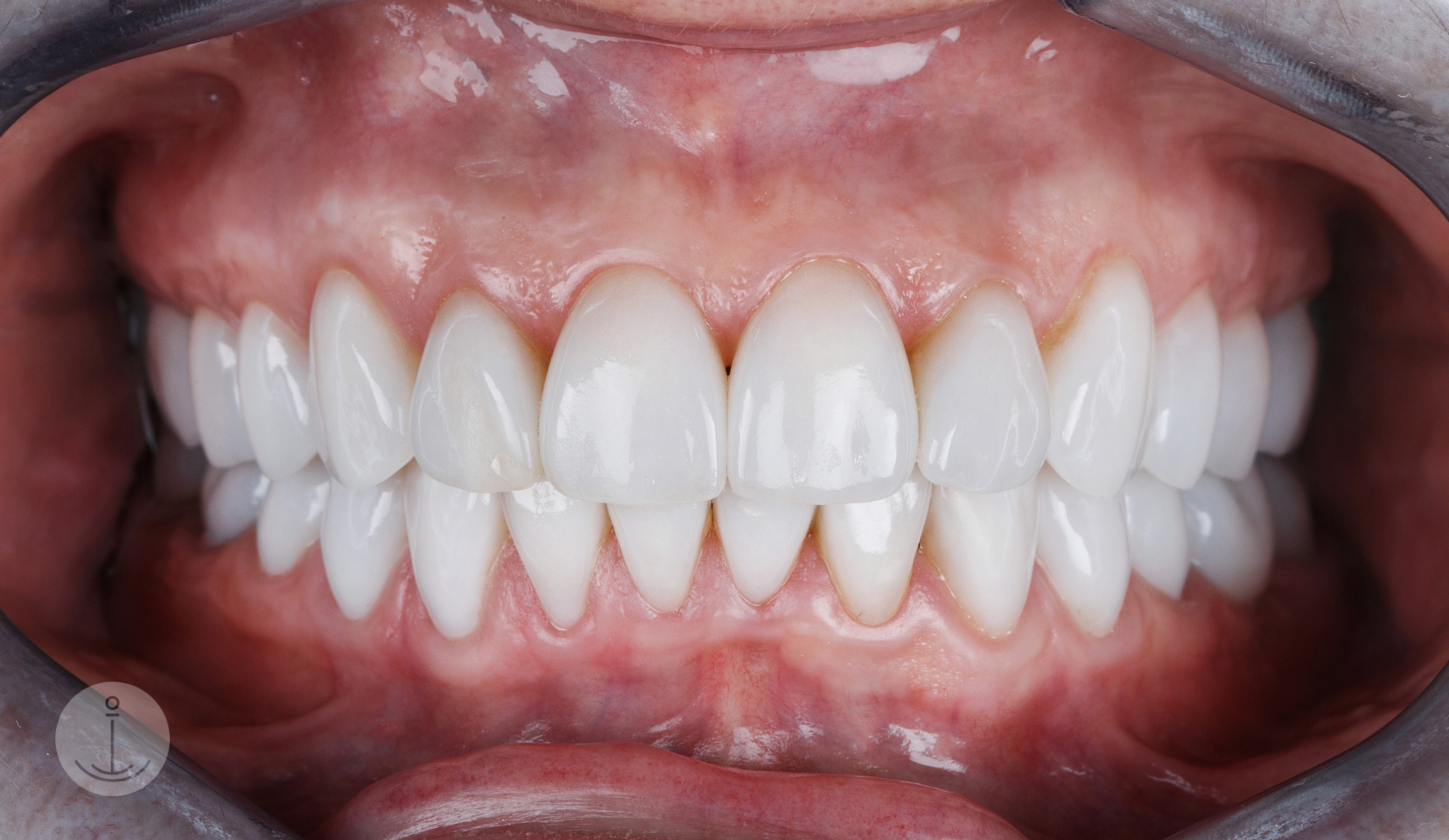 Beratung zu Veneers und Alternativen in der Praxis ANKERZAHN